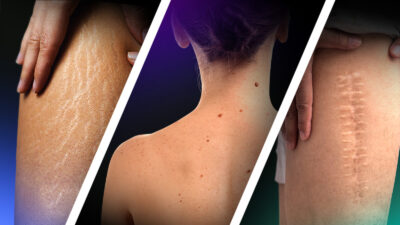 Tattooing Over Moles, Scars and Stretch Marks